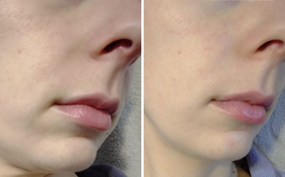 Photos avant et après d'un ambassadeur : Crème riche anti-rougeurs, Eau Thermale Jonzac