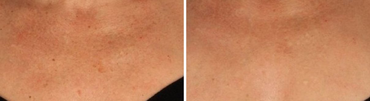 Photos avant et après d'un ambassadeur : Sérum éclat anti-taches Lumi'Lys, SO'BiO étic